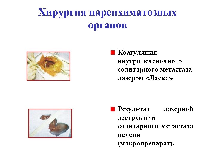 Хирургия паренхиматозных органов Коагуляция внутрипеченочного солитарного метастаза лазером «Ласка» Результат лазерной деструкции солитарного метастаза