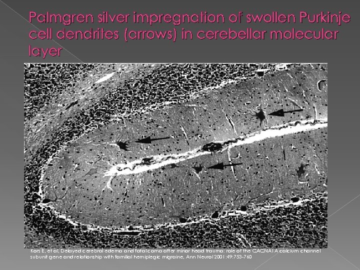 Palmgren silver impregnation of swollen Purkinje cell dendrites (arrows) in cerebellar molecular layer Kors