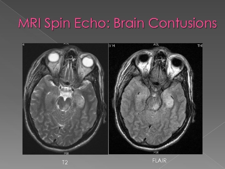 MRI Spin Echo: Brain Contusions T 2 FLAIR 