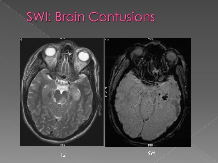 SWI: Brain Contusions T 2 SWI 