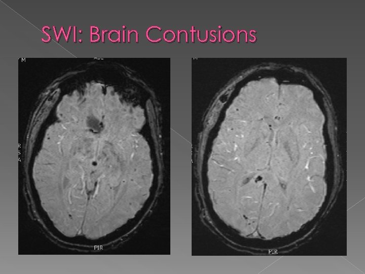 SWI: Brain Contusions 