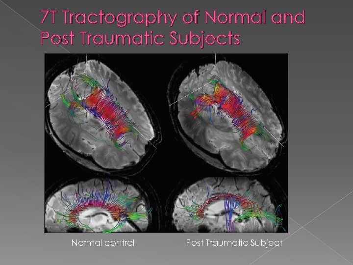 7 T Tractography of Normal and Post Traumatic Subjects Normal control Post Traumatic Subject