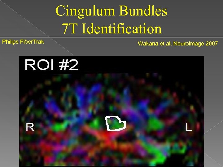 Cingulum Bundles 7 T Identification Philips Fiber. Trak Wakana et al. Neuro. Image 2007