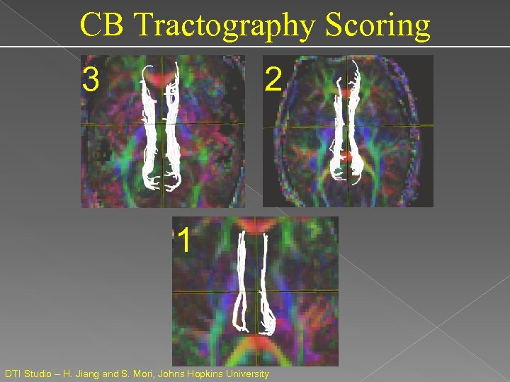 CB Tractography Scoring 2 3 1 DTI Studio – H. Jiang and S. Mori,