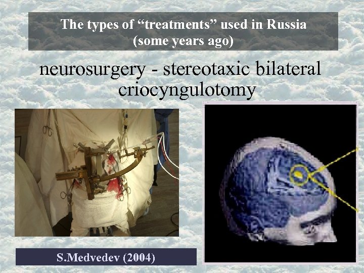 The types of “treatments” used in Russia (some years ago) neurosurgery - stereotaxic bilateral