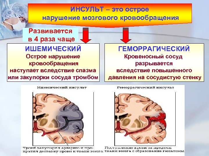 Клиническая картина острого нарушения мозгового кровообращения