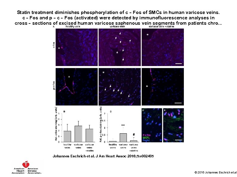 Statin treatment diminishes phosphorylation of c‐Fos of SMCs in human varicose veins. c‐Fos and