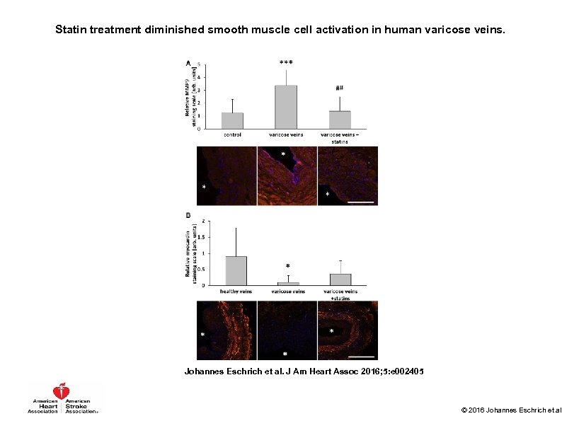 Statin treatment diminished smooth muscle cell activation in human varicose veins. Johannes Eschrich et