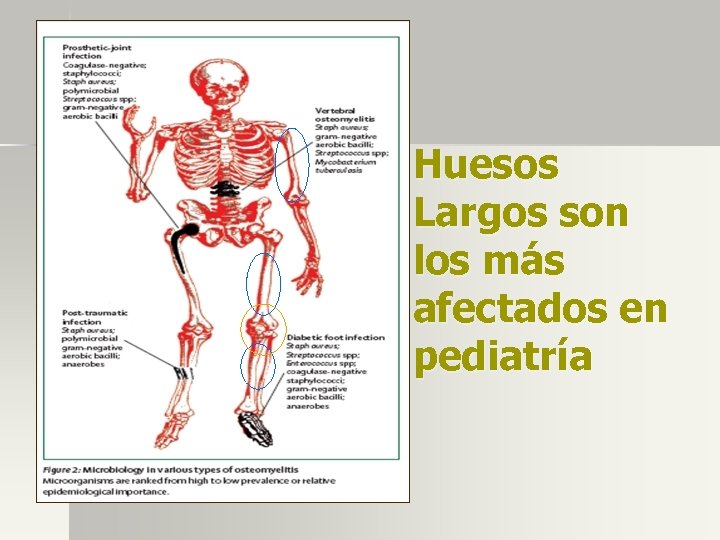 Huesos Largos son los más afectados en pediatría 