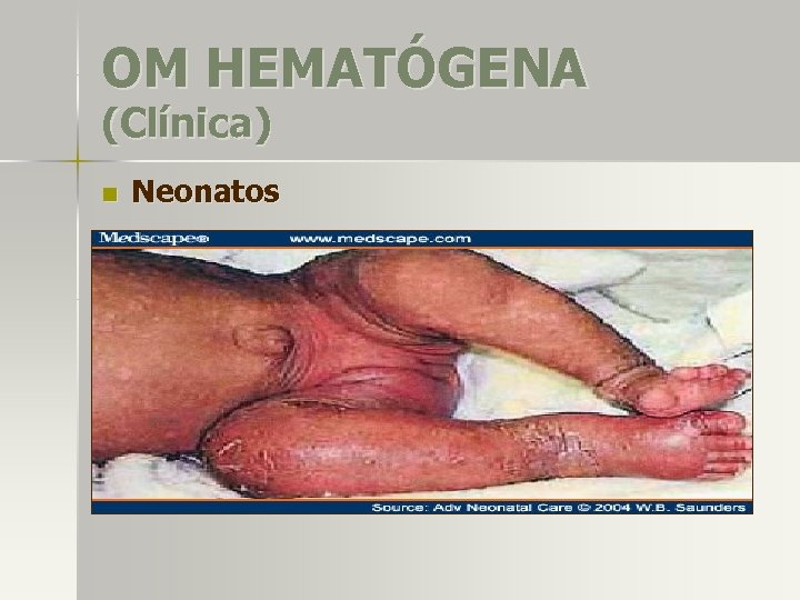 OM HEMATÓGENA (Clínica) n Neonatos . Poco frecuente. S. aureus, BEGN, SGB. Infección severa