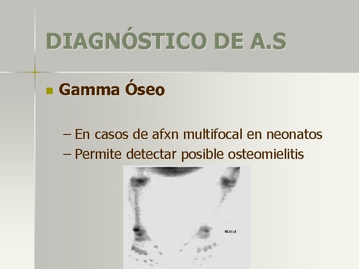 DIAGNÓSTICO DE A. S n Gamma Óseo – En casos de afxn multifocal en