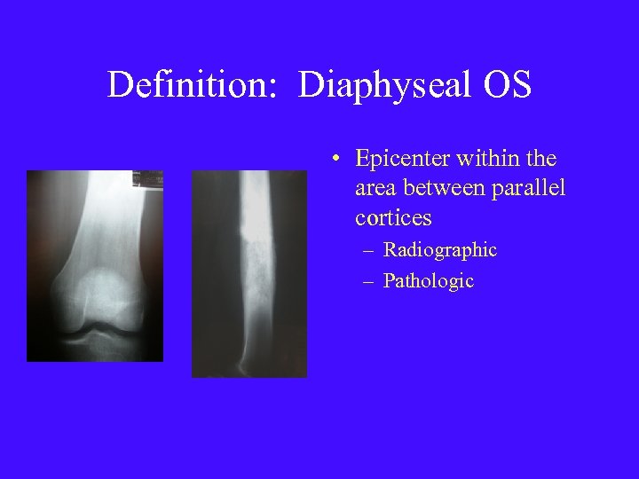 Definition: Diaphyseal OS • Epicenter within the area between parallel cortices – Radiographic –