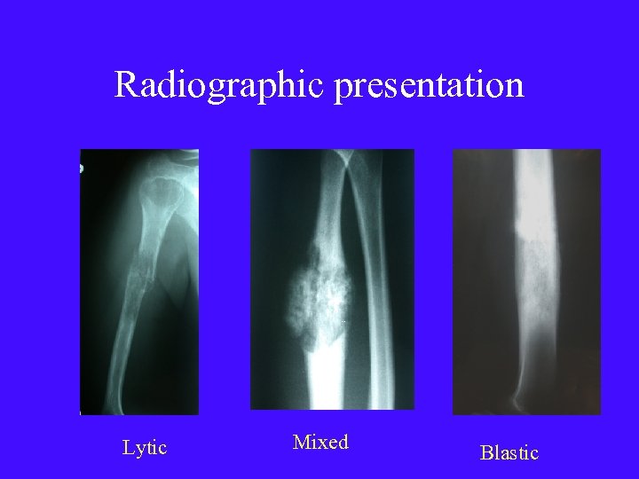 Radiographic presentation Lytic Mixed Blastic 