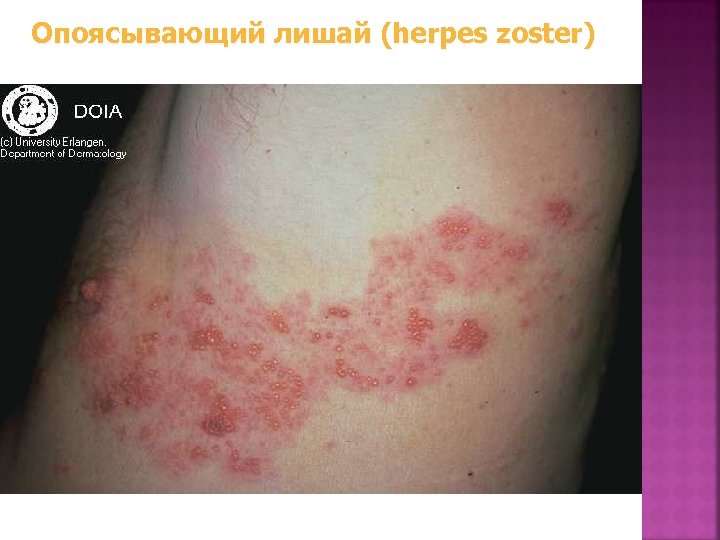 Опоясывающий лишай (herpes zoster) 