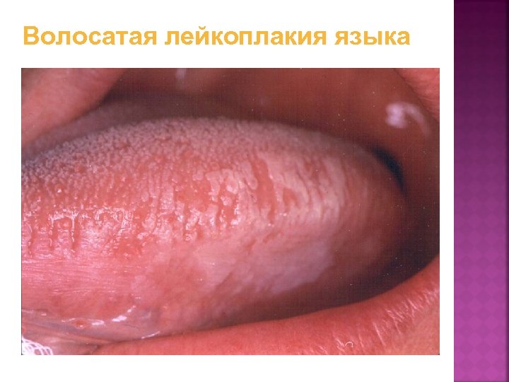 Волосатая лейкоплакия языка 