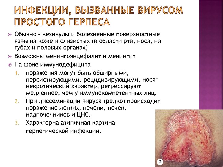 ИНФЕКЦИИ, ВЫЗВАННЫЕ ВИРУСОМ ПРОСТОГО ГЕРПЕСА Обычно – везикулы и болезненные поверхностные язвы на коже