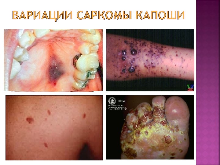 ВАРИАЦИИ САРКОМЫ КАПОШИ 