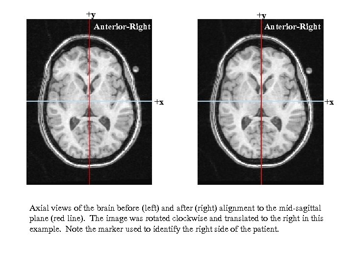 +y Anterior-Right +x Axial views of the brain before (left) and after (right) alignment