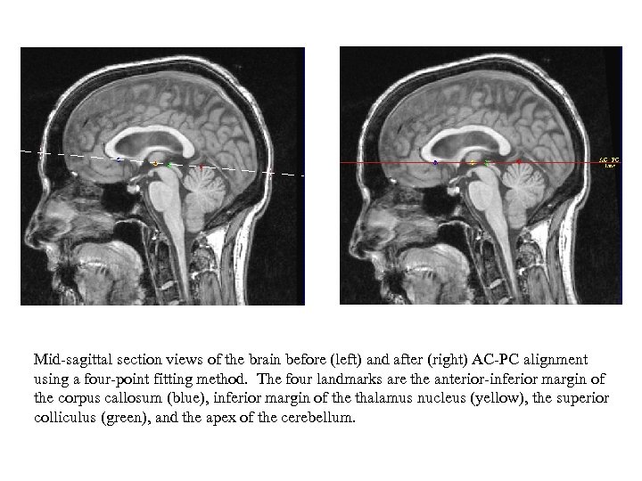 Mid-sagittal section views of the brain before (left) and after (right) AC-PC alignment using