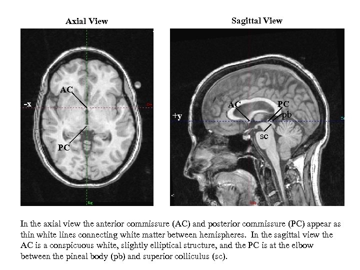 Sagittal View Axial View AC -x PC AC pb +y sc PC In the