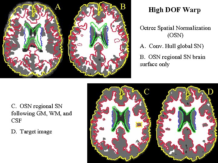A B High DOF Warp Octree Spatial Normalization (OSN) A. Conv. Hull global SN)