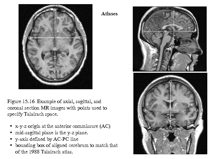 Atlases Figure 15. 16 Example of axial, sagittal, and coronal section MR images with