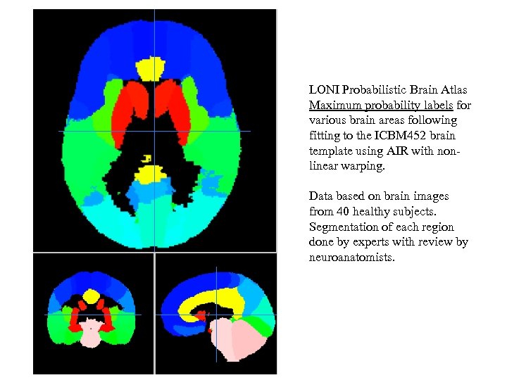 LONI Probabilistic Brain Atlas Maximum probability labels for various brain areas following fitting to