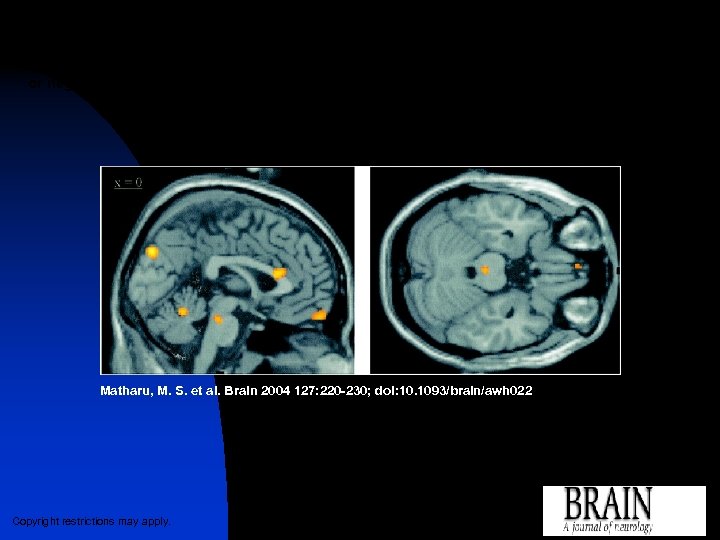 Statistical parametric map (SPM{F}) showing brain regions in which r. CBF correlates (positively or