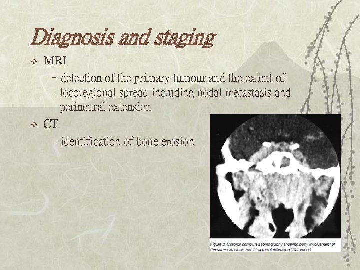 Diagnosis and staging v v MRI –detection of the primary tumour and the extent