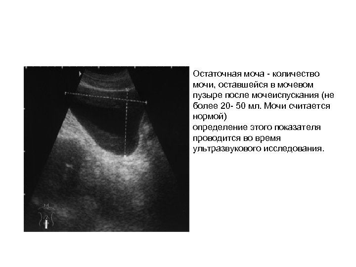 Остаточная моча - количество мочи, оставшейся в мочевом пузыре после мочеиспускания (не более 20