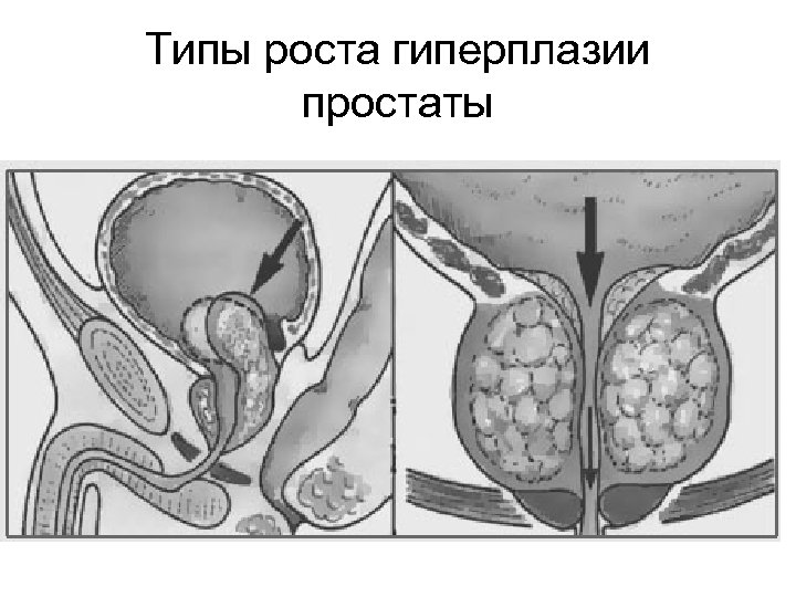  Типы роста гиперплазии простаты 