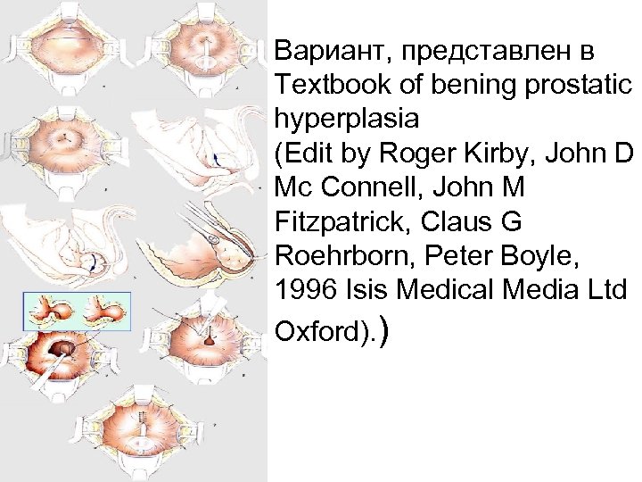 Вариант, представлен в Textbook of bening prostatic hyperplasia (Edit by Roger Kirby, John D