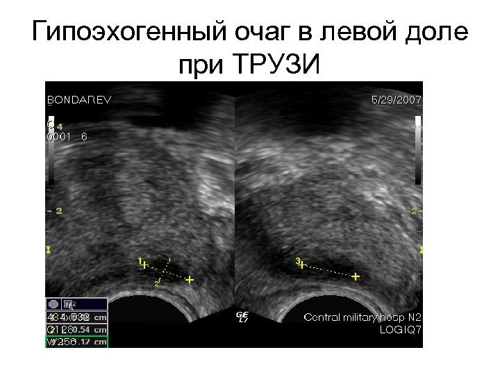 Гипоэхогенный очаг в левой доле при ТРУЗИ 