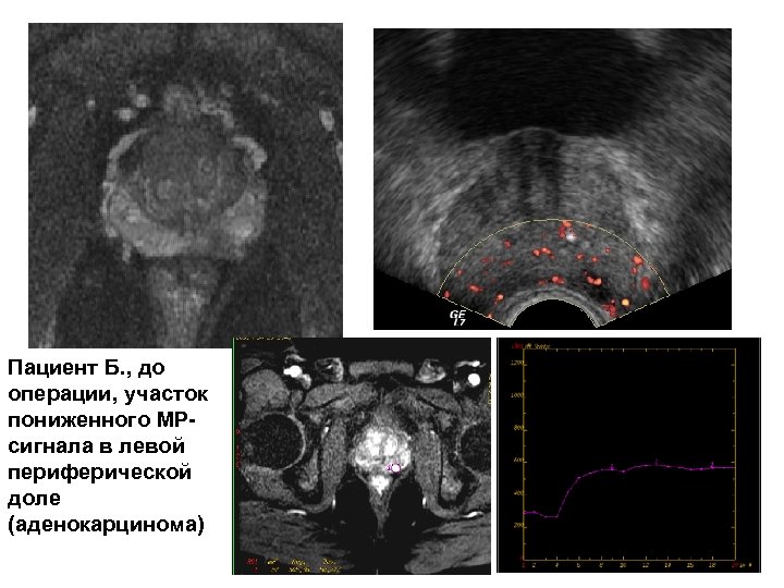 Пациент Б. , до операции, участок пониженного МРсигнала в левой периферической доле (аденокарцинома) 