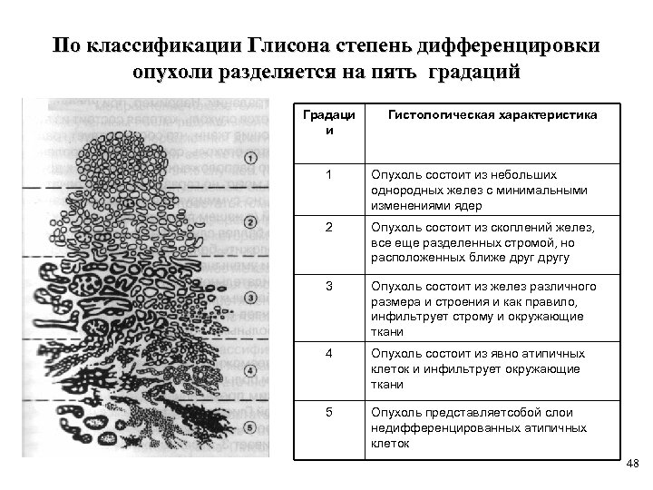 По классификации Глисона степень дифференцировки опухоли разделяется на пять градаций Градаци и Гистологическая характеристика