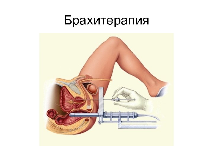 Брахитерапия 