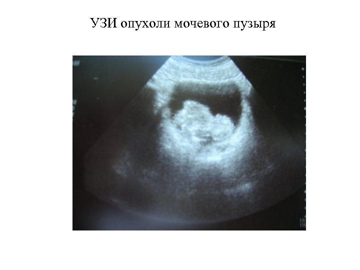 УЗИ опухоли мочевого пузыря 