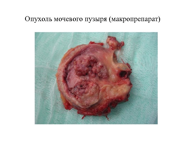 Опухоль мочевого пузыря (макропрепарат) 