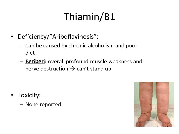 Thiamin/B 1 • Deficiency/”Ariboflavinosis”: – Can be caused by chronic alcoholism and poor diet