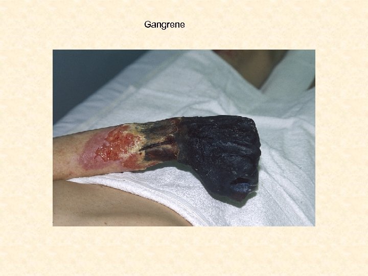 Gangrene 