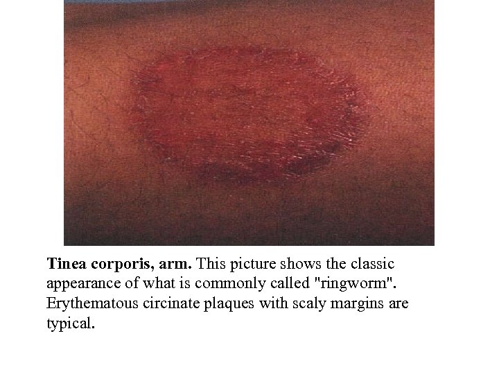 Tinea corporis, arm. This picture shows the classic appearance of what is commonly called