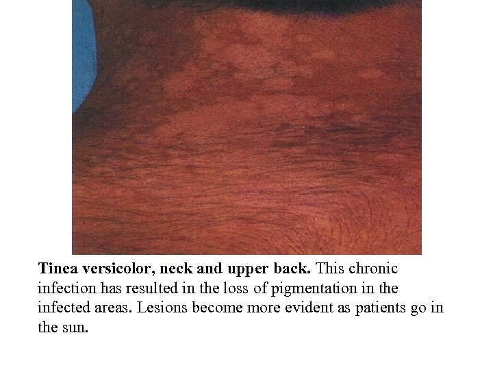 Tinea versicolor, neck and upper back. This chronic infection has resulted in the loss