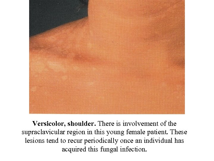 Versicolor, shoulder. There is involvement of the supraclavicular region in this young female patient.