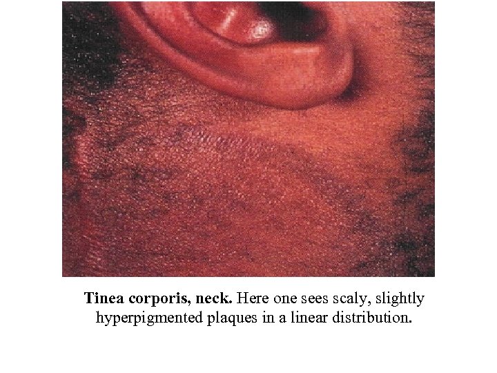 Tinea corporis, neck. Here one sees scaly, slightly hyperpigmented plaques in a linear distribution.