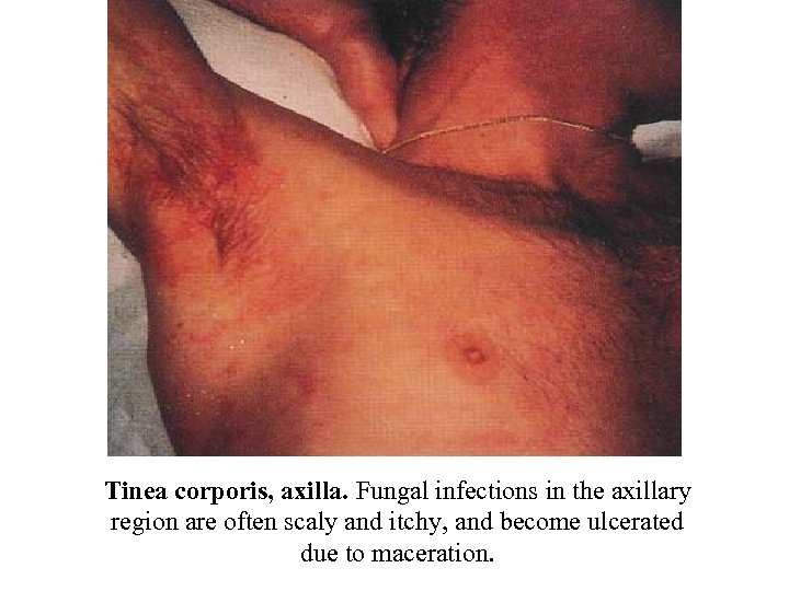 Tinea corporis, axilla. Fungal infections in the axillary region are often scaly and itchy,