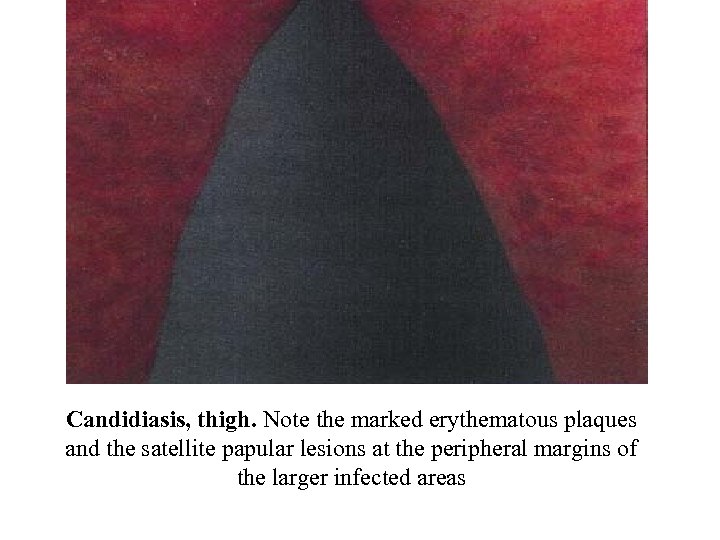 Candidiasis, thigh. Note the marked erythematous plaques and the satellite papular lesions at the