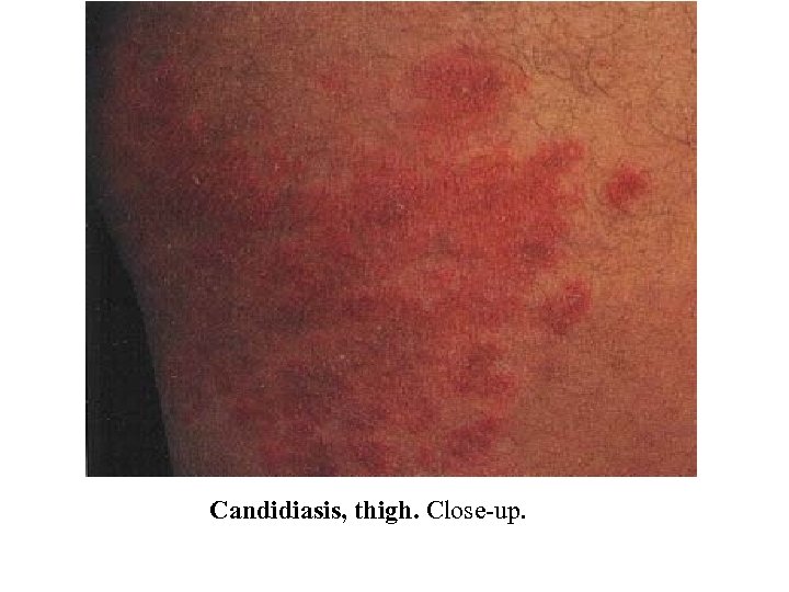 Candidiasis, thigh. Close-up. 