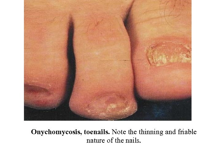 Onychomycosis, toenails. Note thinning and friable nature of the nails. 