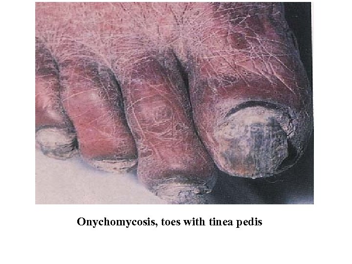 Onychomycosis, toes with tinea pedis 