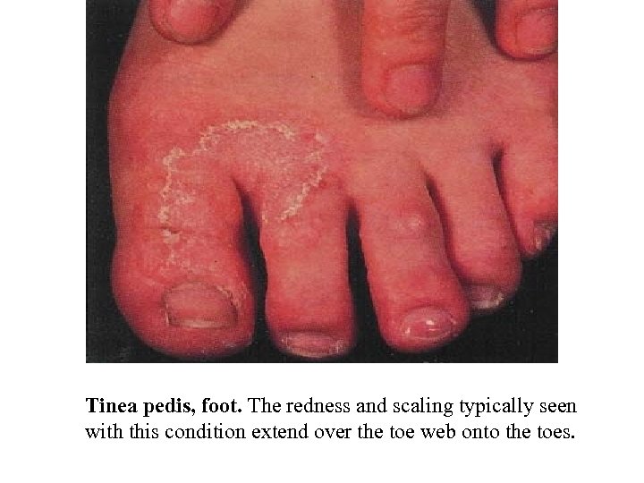 Tinea pedis, foot. The redness and scaling typically seen with this condition extend over